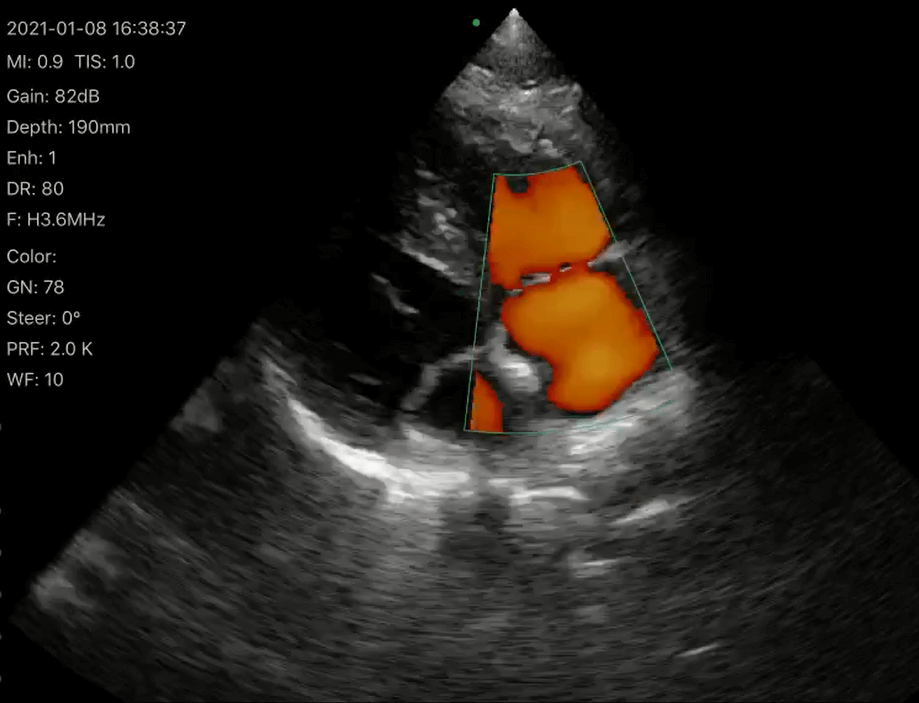 Wireless Palm Ultrasound Used in Cardiology